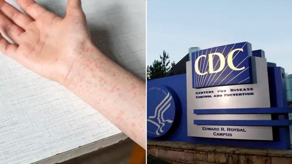 Texas’ measles outbreak explodes to 561 cases Texas’ measles outbreak explodes to 561 cases
