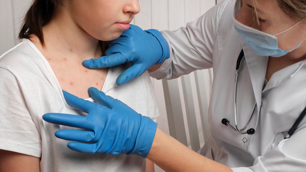 Virginia confirms child infected with first measles case in the state Virginia confirms child infected with first measles case in the state