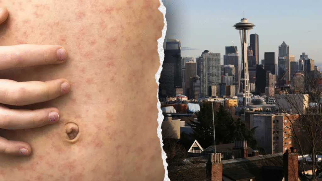 Measles exposure alert at Seattle airport after Canadian traveler visits Washington state