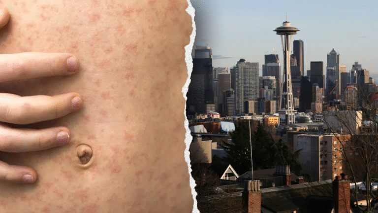 Measles exposure alert at Seattle airport after Canadian traveler visits Washington state