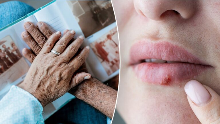 Alzheimer’s disease risk linked to cold sores, similar viruses in new study