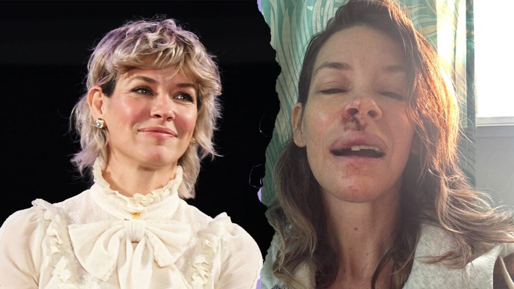 Evangeline Lilly shares photos of injuries after beach blackout incident