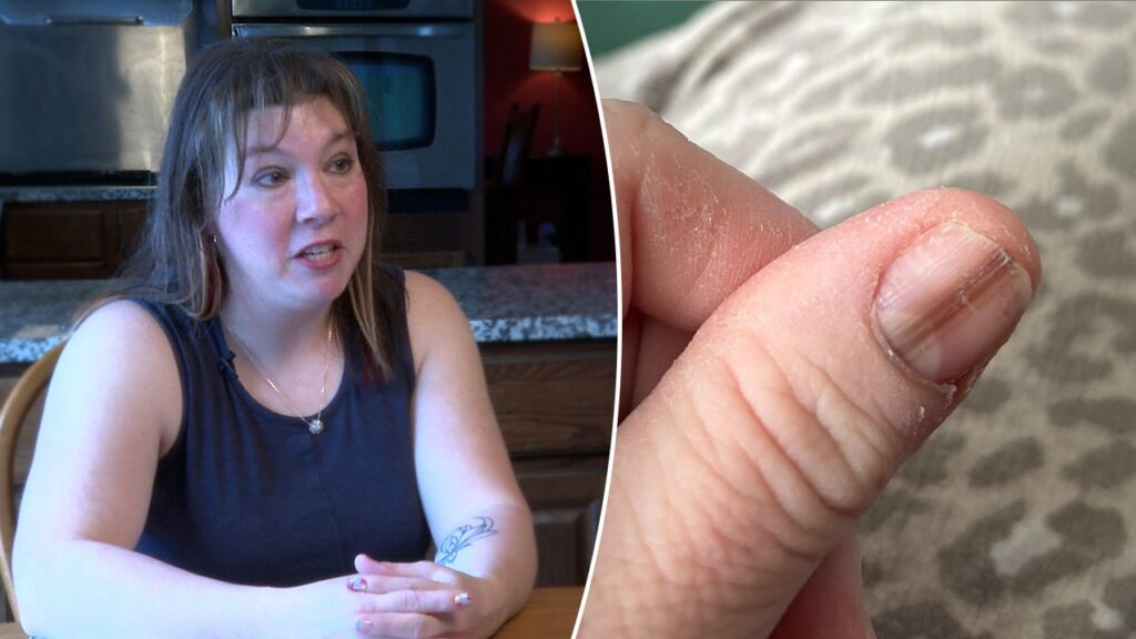 Brown line on fingernail helped catch cancer early, thanks to TikTok video