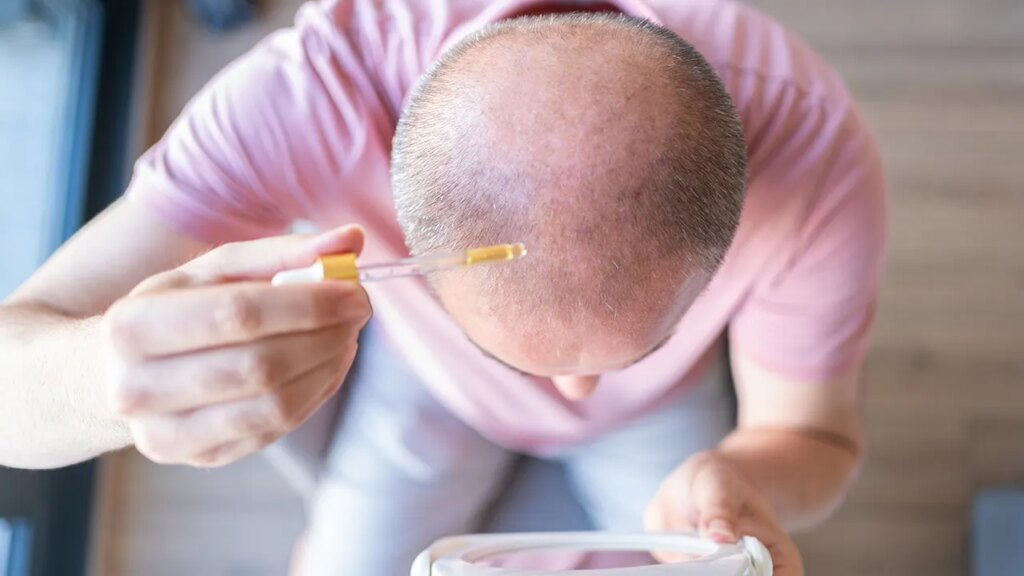 New baldness therapy could regrow hair in 20 days using serum treatment
