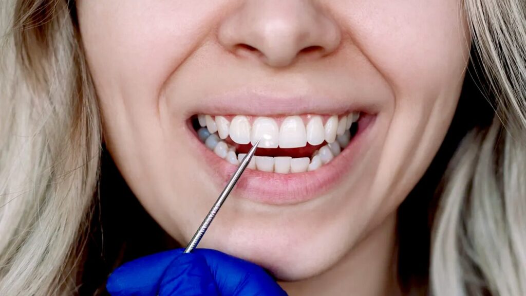 Scientists use human hair proteins to repair damaged tooth enamel